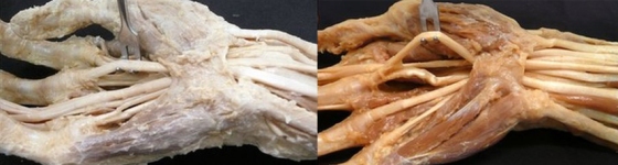 A comparison between traditional formalin embalming (left) and the more realistic Thiel technique (right)