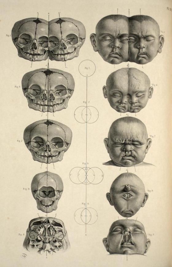 'Head and skull of malformed infants; conjoined twins, bilateral cleft lip and holoprosencephaly' from 'Surgical Anatomy' by Joseph Maclise, 1856.