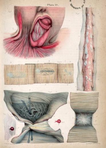 4. 'Neoplasm from a rabbit, cartilagenous deposits on the spinal cord, ulcerated Peyer's patches on the small intestine, ulcerated small intestine, intestinal stricture, contractile tissue from a healed burn.' from 'Pathological Anatomy' by Sir Robert Carswell, 1838.