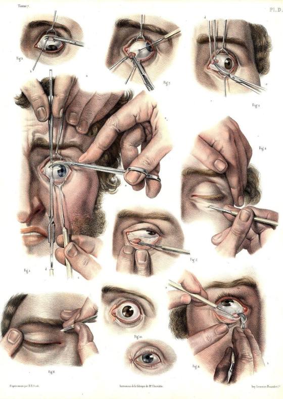 2. 'Surgical technique for correcting a lazy eye' from 'Traite complet de l'anatomie de l'homme' by Jean Baptiste Marc Bourgery, 1831.