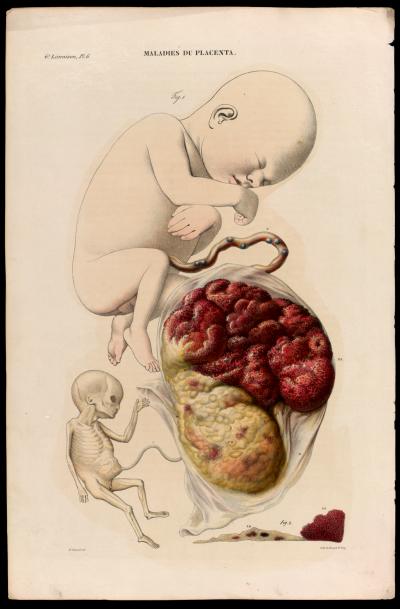 3. 'Abnormal twins and placenta' from 'Anatomie pathologique du corps humain' by Jean Cruveilhier, 1829