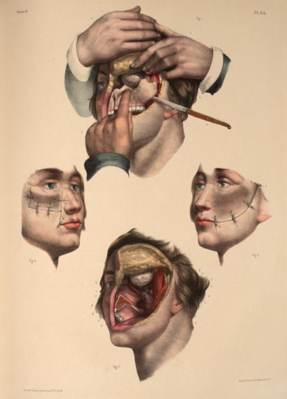 2. 'Resection of the maxilla' by Nicolas Henri Jacob from 'Traité complet de l'anatomie de l'homme' by Marc Jean Bourgery, 1831. Anaesthetic was first used in 1846... 