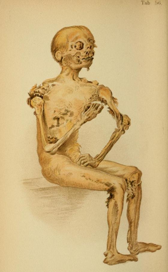 1. 'Mummified cadaver' from Atlas of Legal Medicine by Eduard von Hofmann, 1898. The body of this 50 year old man wasn't discovered until 10 years after he hanged himself in his attic. 
